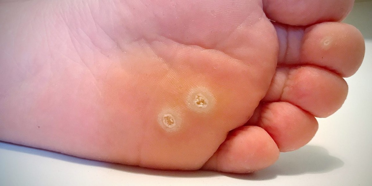 Стрижневий мозоль