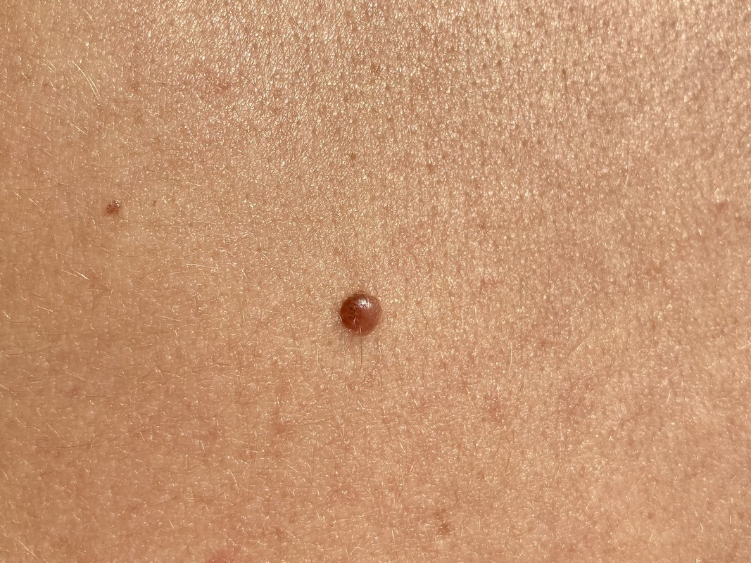 випукла родимка