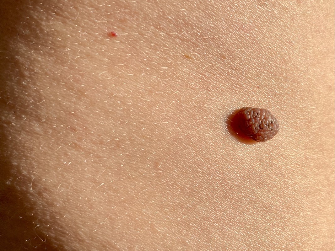 злоякісна родимка