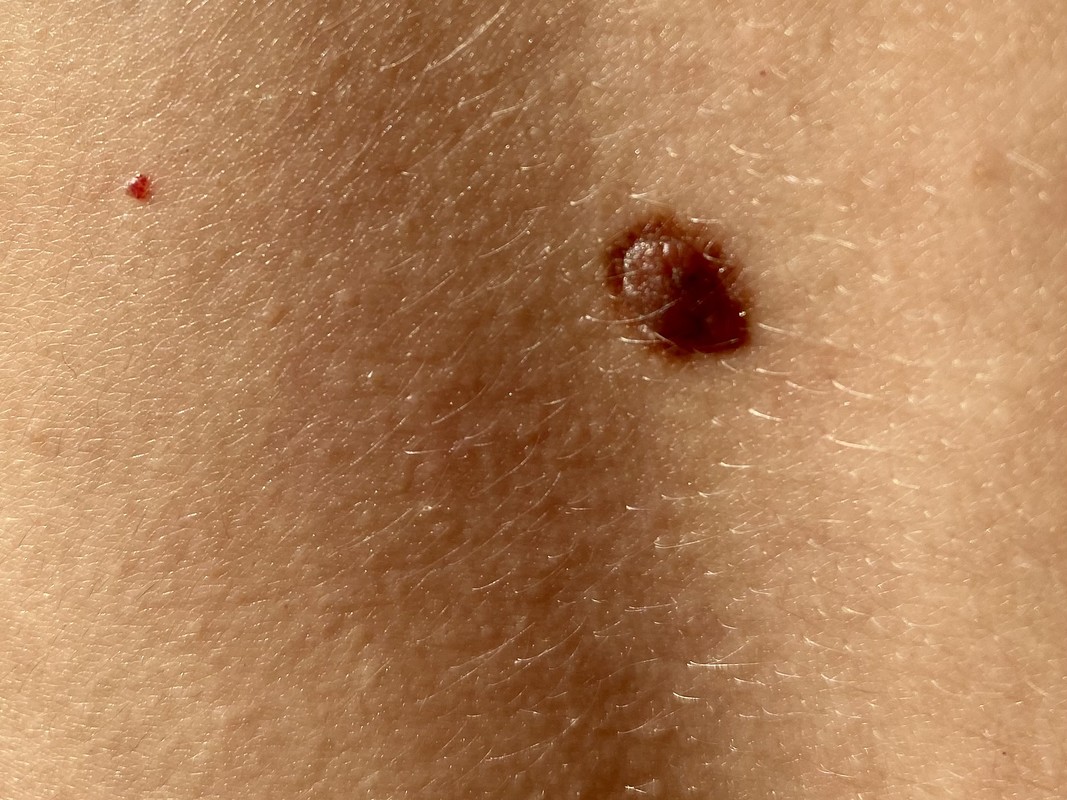 небезпечні родимки