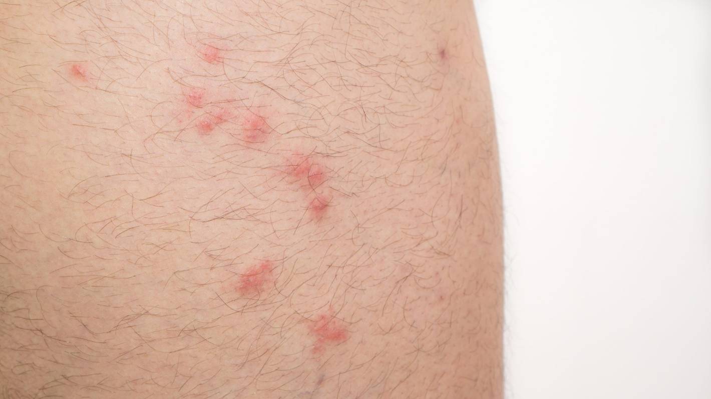 Блошиный укус