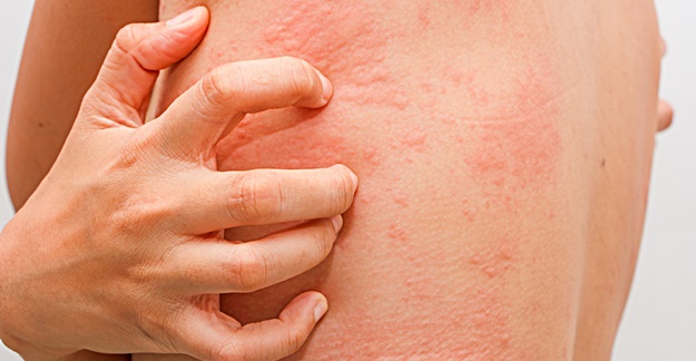 Лекарственная аллергия