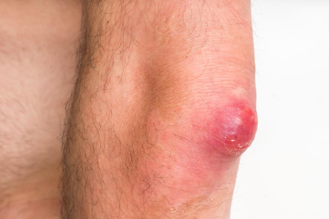 Карбункули на руці