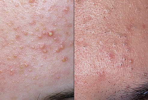 прищі на лобі