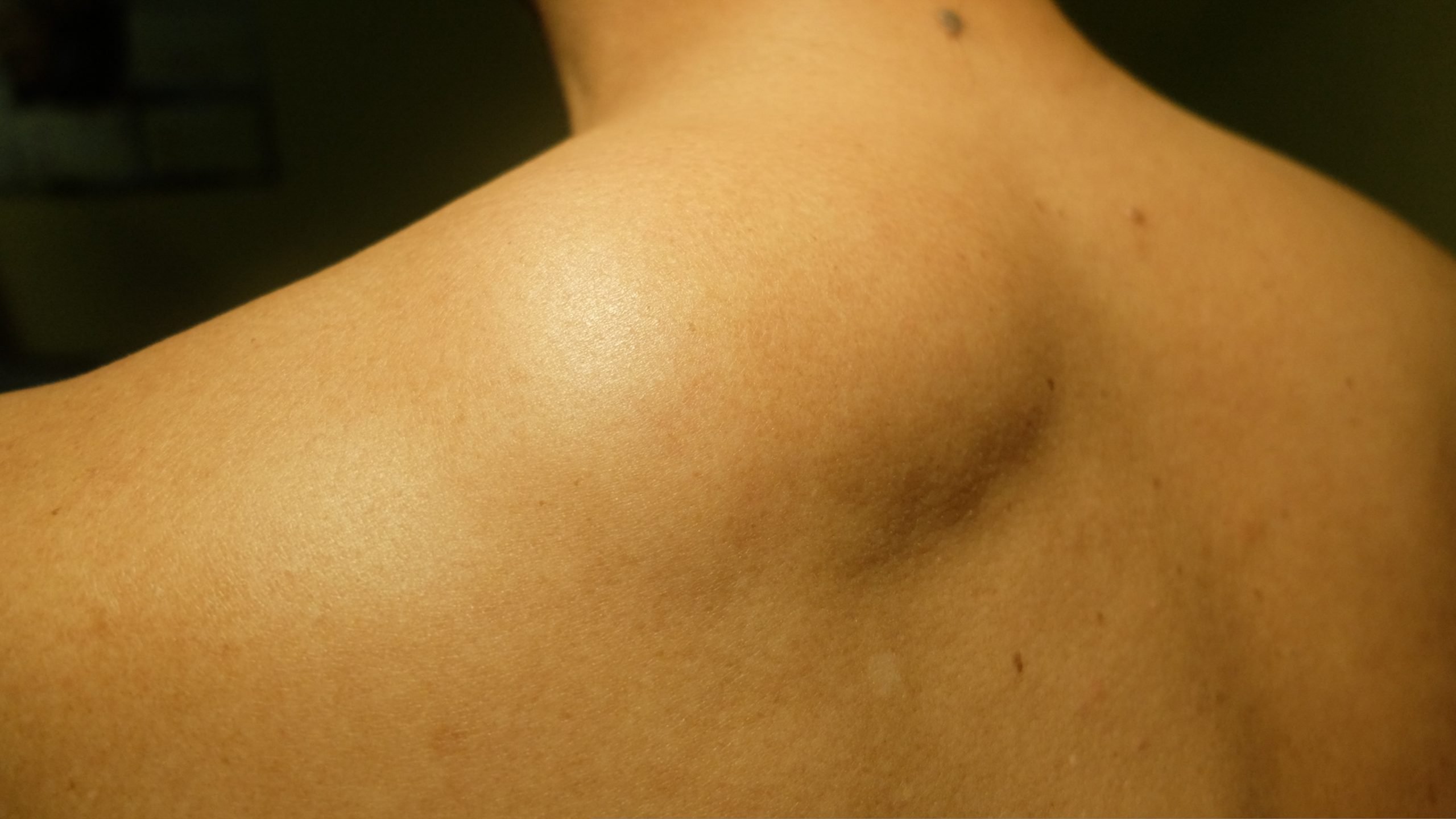 Липома на спине