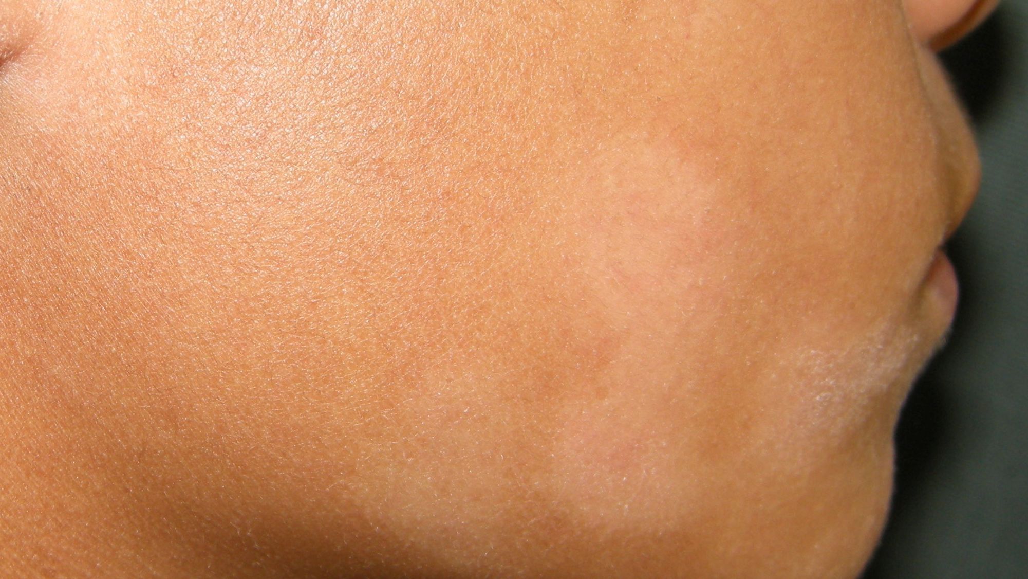 Лишай на обличчі